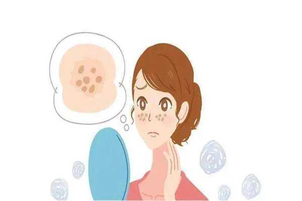 黄褐斑是怎么样形成的 黄褐斑是怎么样形成的