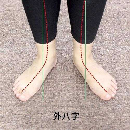 什么是外八字脚 什么是外八字脚