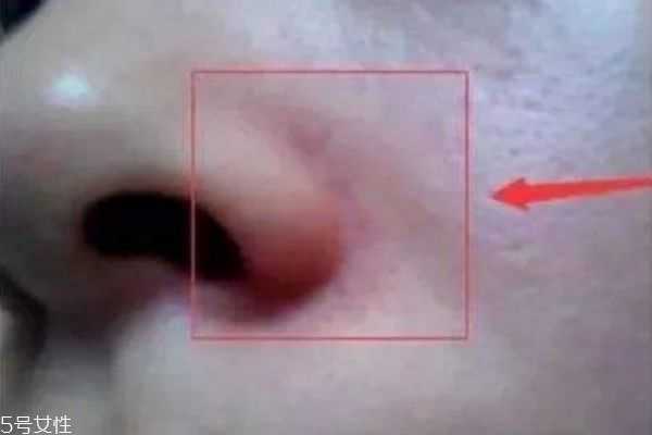 如何消除鼻翼两侧发红 鼻翼两侧发红有血丝