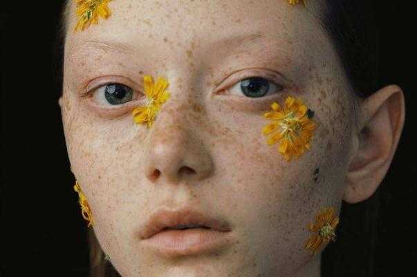 雀斑的形状和颜色 雀斑的危害