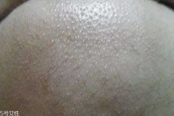 下巴上的粉刺能不能挤 下巴上的粉刺能不能挤