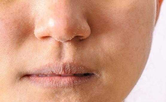 冬季皮肤干燥是怎么回事？皮肤干燥要怎么缓解推荐5大妙招