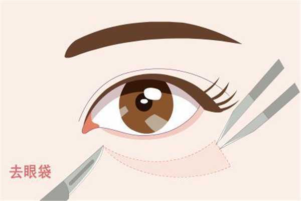眼袋按摩可以消除吗 眼袋按摩可以消除吗