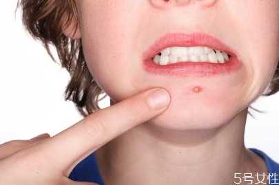 戴口罩下巴长痘痘怎么办？怎样避免戴口罩闷痘