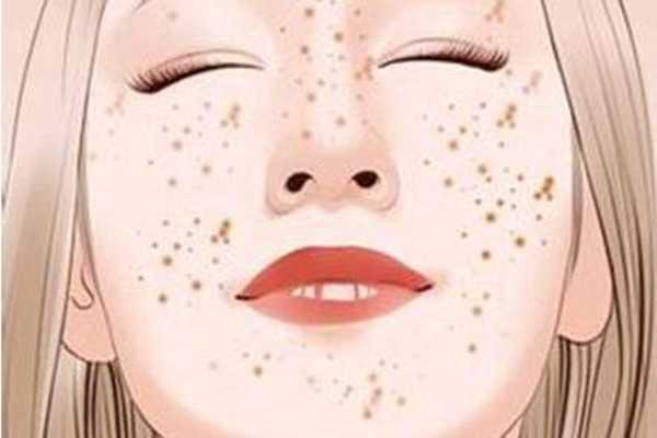 晒斑可以自然消失吗？晒斑可以用激光去掉吗