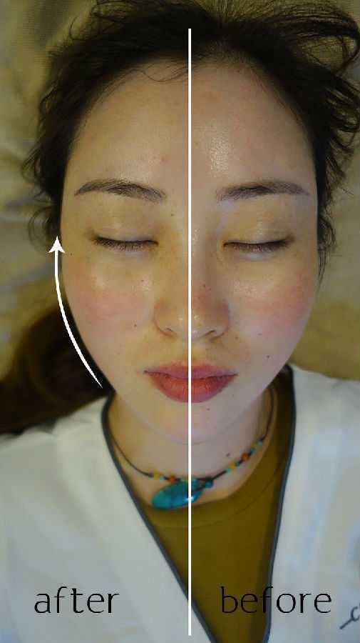 徒手整骨整形前后对比照片