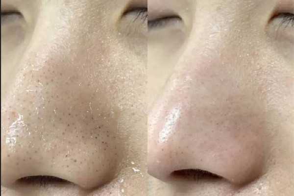 黑头是怎么形成的？