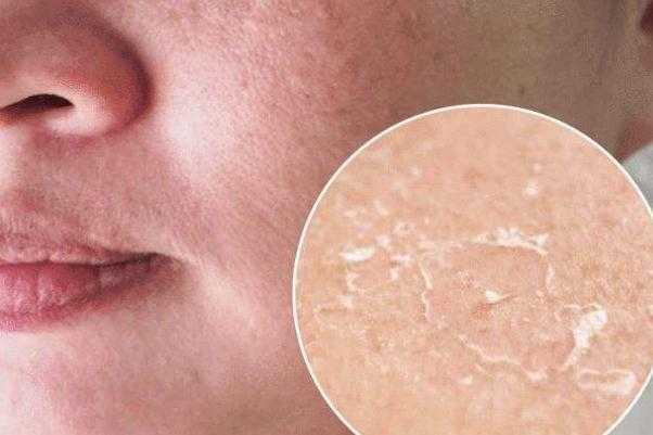 皮肤干燥脱皮严重像鱼鳞怎么办