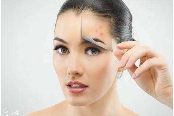 怎么去除色素沉着 色素沉着的原因