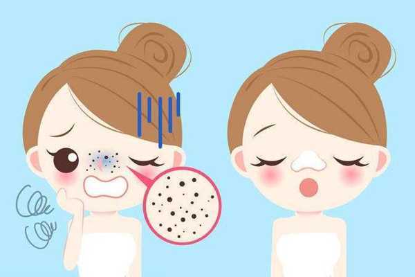 黑头要定期清理吗?黑头多久清理一次比较好 黑头要定期清理吗?黑头多久清理一次比较好