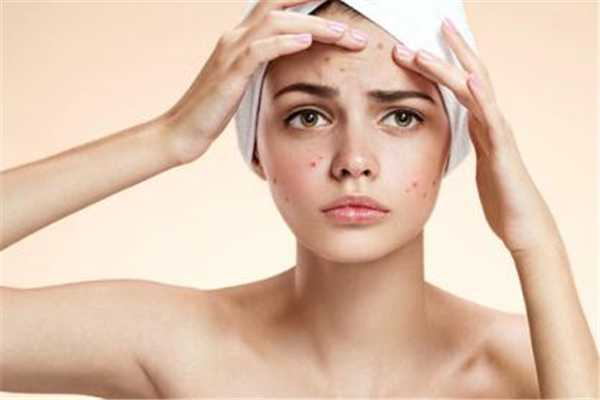 夏天脸上长痘痘怎么回事?为什么夏天脸上爱长痘 夏天脸上长痘痘怎么回事?为什么夏天脸上爱长痘