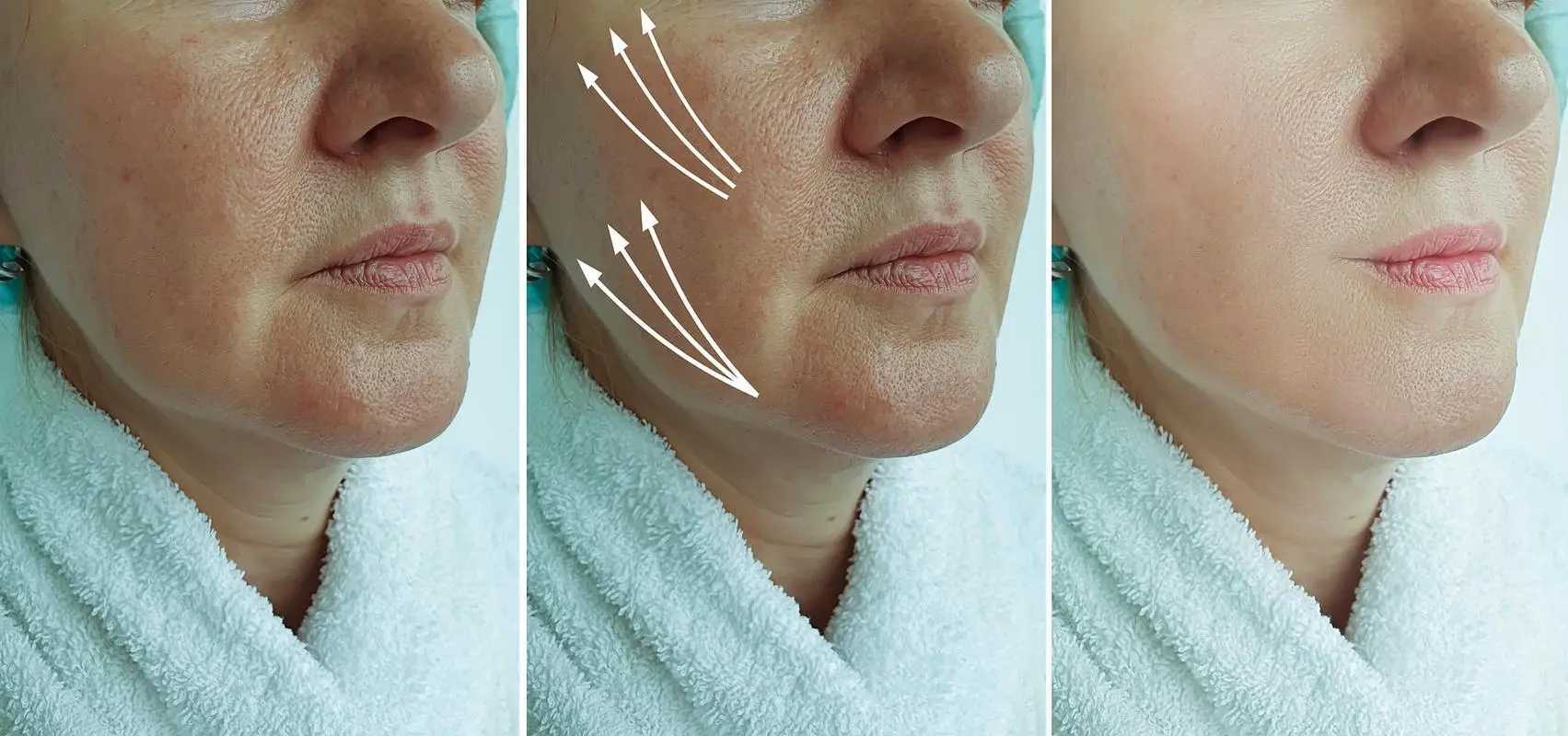 面部筋膜提拉术安全吗