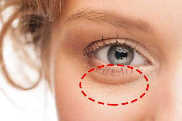 怎么区分脂肪粒和闭口