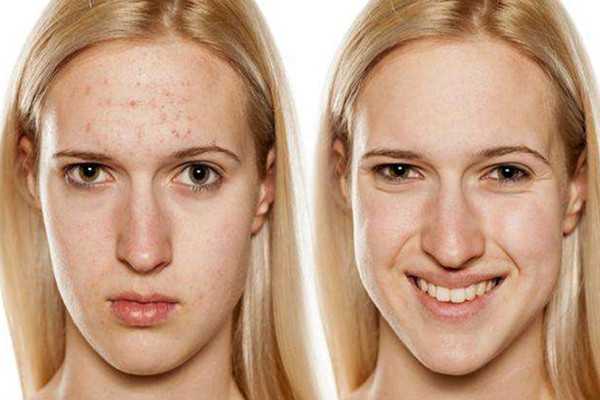 长痘痘能化妆吗 长痘痘能化妆吗