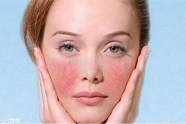 洋甘菊去红血丝吗