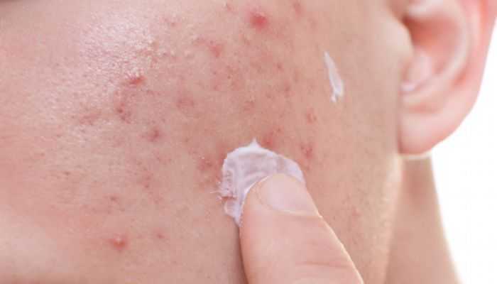 星期四茶树精油的使用方法 星期四茶树精油的使用方法