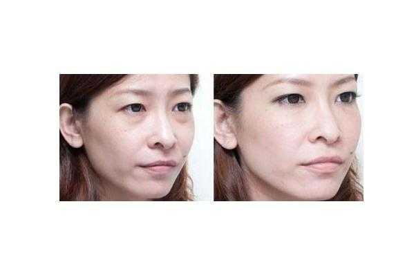 眼袋有细纹了怎么消除 眼袋上有细纹怎么解决