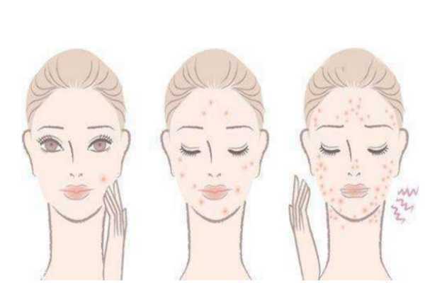 去痘印最快的方法