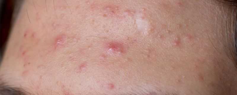 粉刺是怎么形成的 粉刺是怎么形成的