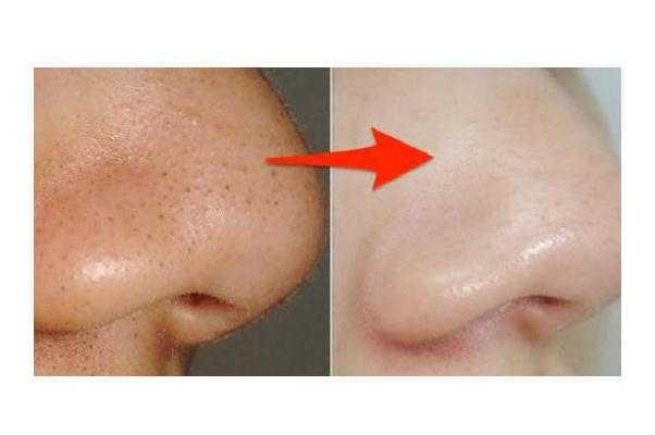 粉刺会疼吗 粉刺会疼是为什么