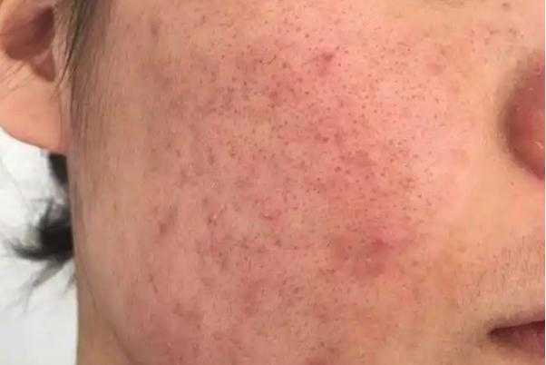 毛孔粗大有痘坑怎么修复 毛孔粗大有几种类型