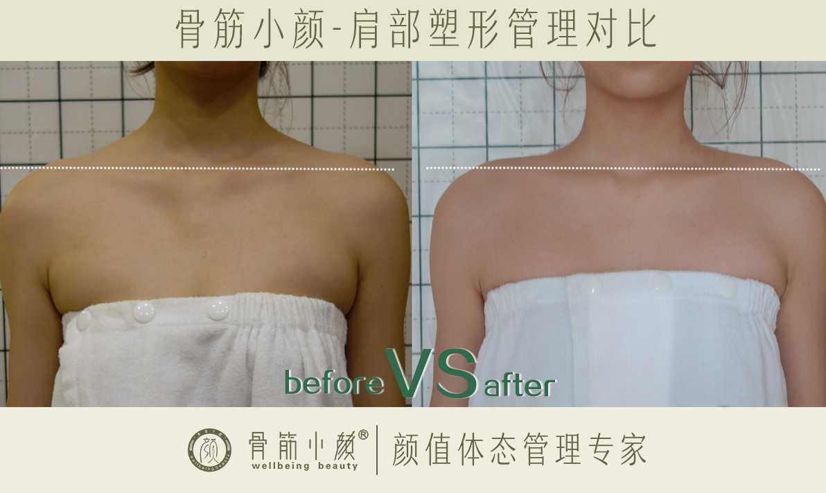 日式整骨对肩部斜方肌塑形有效果吗 日式整骨对肩部斜方肌塑形有效果吗