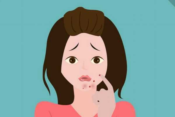 女生下巴长痘的原因有什么 为什么女生下巴会长痘