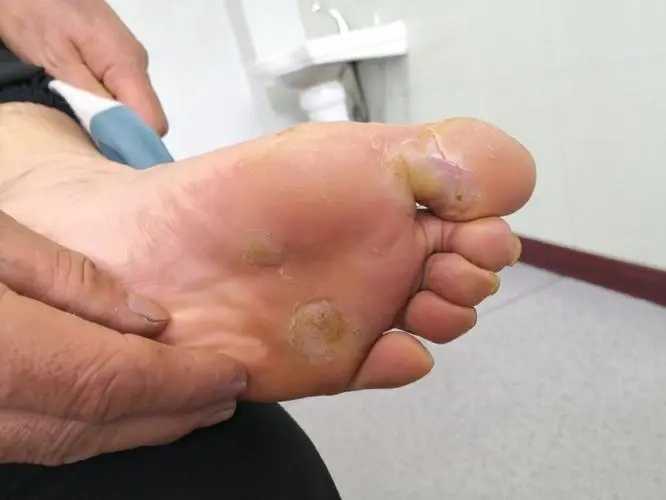 感染hpv的痘痘长啥样(附图) 感染hpv的痘痘长啥样(附图)