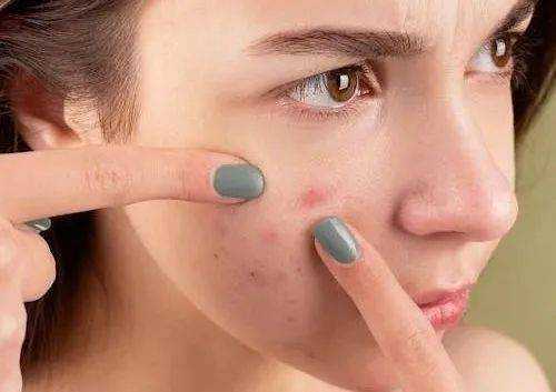 如何科学有效地祛痘印呢 如何科学有效地祛痘印呢