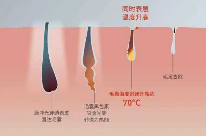 脱毛仪是智商税吗 脱毛仪是智商税吗