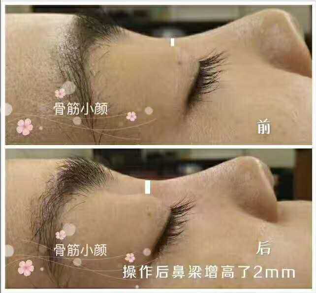 徒手整骨整形前后对比照片