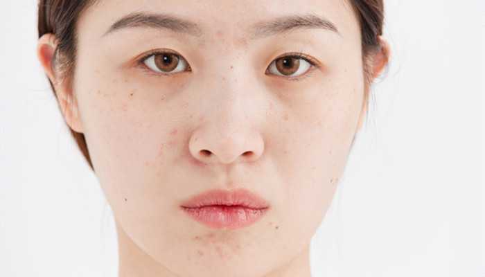 生姜涂脸可以祛痘吗 生姜涂脸可以祛痘吗