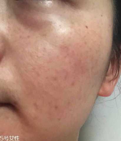 海本修护冻干粉怎么样 海本修护冻干粉怎么样