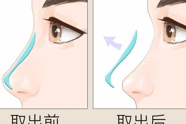 鼻子黑头是怎么回事 鼻子黑头是怎么回事