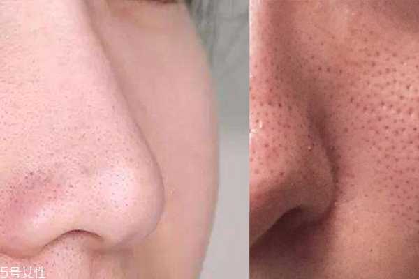 油性皮肤毛孔怎么缩小