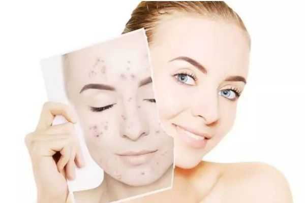 长痘期的需要用什么护肤品