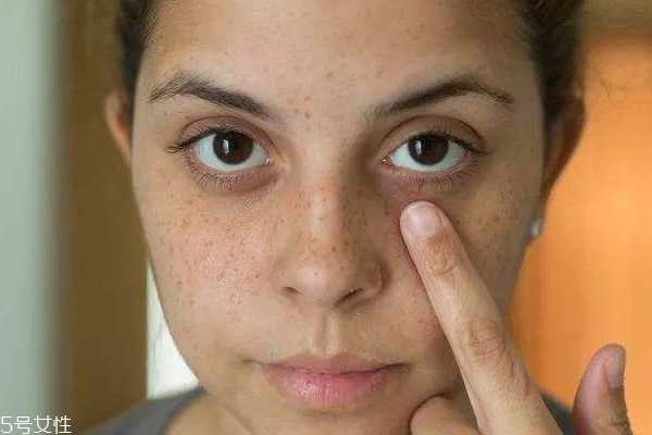 晒后多久会变黑