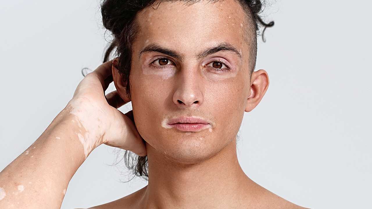 面部有白癜风如何洗脸?白癜风患者如何选择洁面产品? 面部有白癜风如何洗脸?白癜风患者如何选择洁面产品?