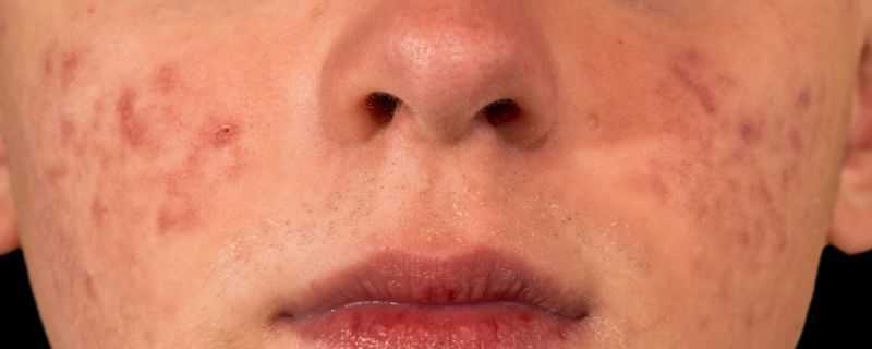 维生素哪个美白祛痘印 维生素哪个美白祛痘印