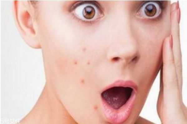熬夜起痘痘能挤吗