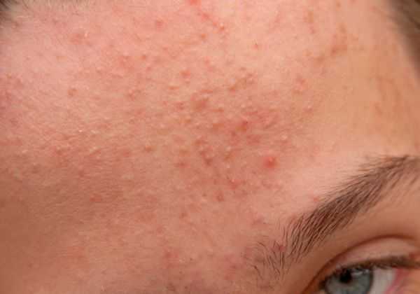 生理盐水可以治疗闭口吗 生理盐水可以治疗闭口吗