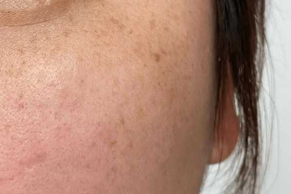 晒斑怎么去除掉？晒斑能彻底根除吗