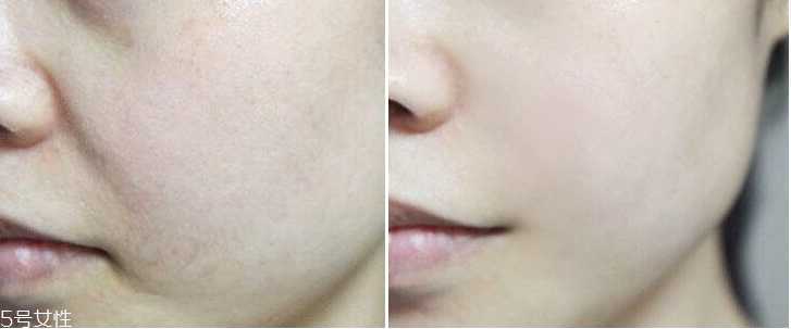 微针眼膜能天天使用吗 一个礼拜用一次