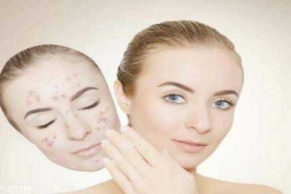 激素脸治疗方法