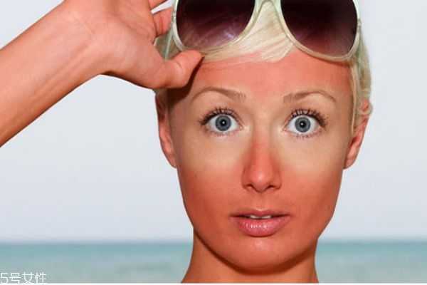 暴晒后怎么办 暴晒后怎么办