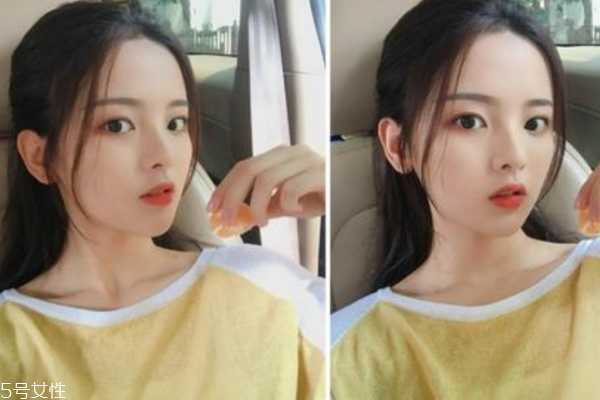 为什么嘴巴总是长痘痘 反复滋长4个原因