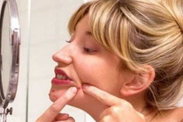 下巴上的粉刺能不能挤 下巴上的粉刺能不能挤