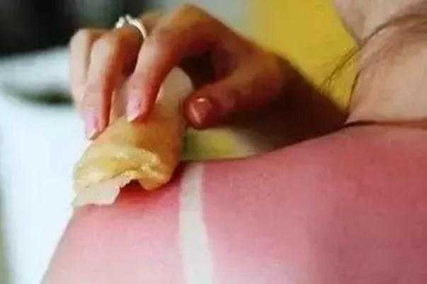 皮肤晒伤后留下黑色素该怎么去除 皮肤晒伤发红擦什么药