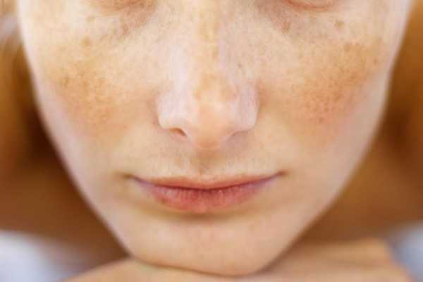 黄褐斑会不会遗传?黄褐斑会不会越长越多 黄褐斑会不会遗传?黄褐斑会不会越长越多