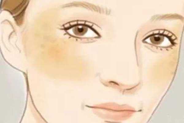 晒斑是什么样子的 晒斑是什么样子的